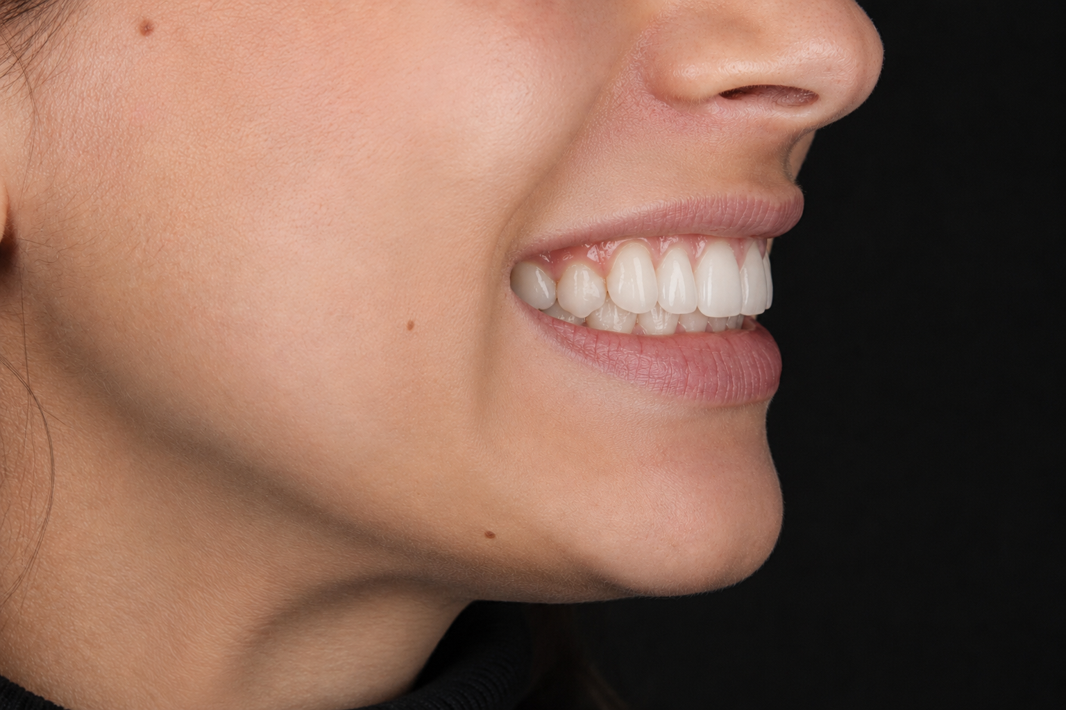 Aligners After