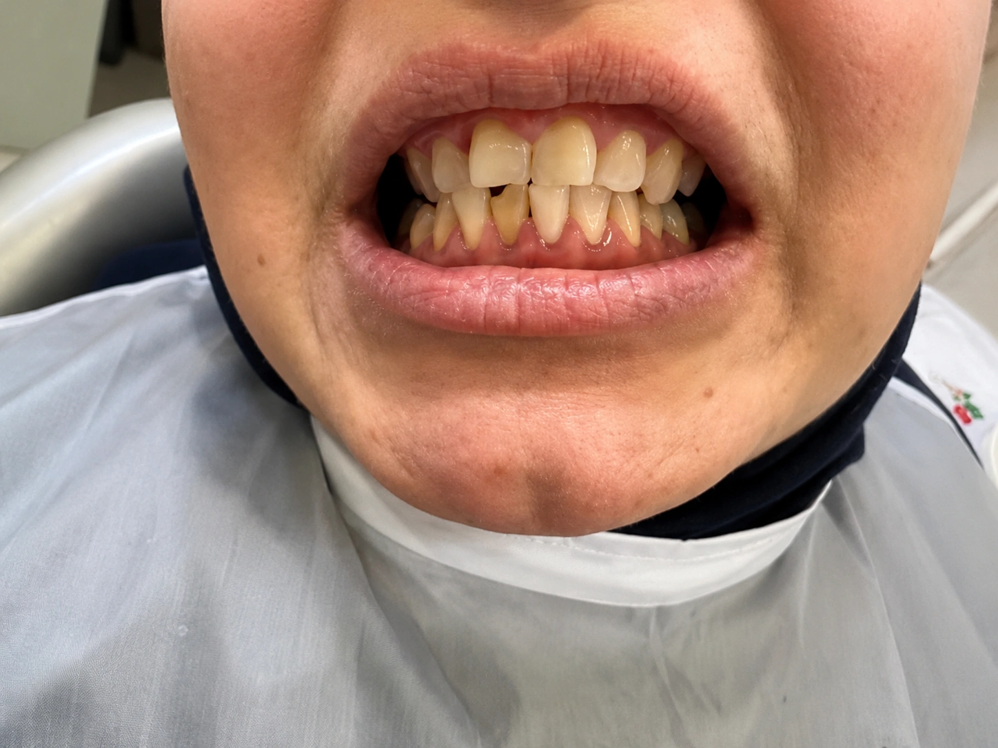 Teeth Bleaching Before