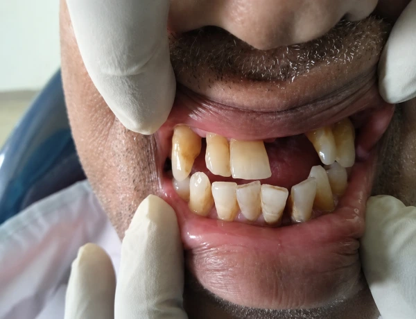 Rehabilitation Before