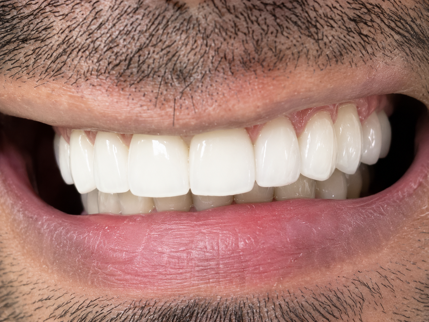 Veneers After