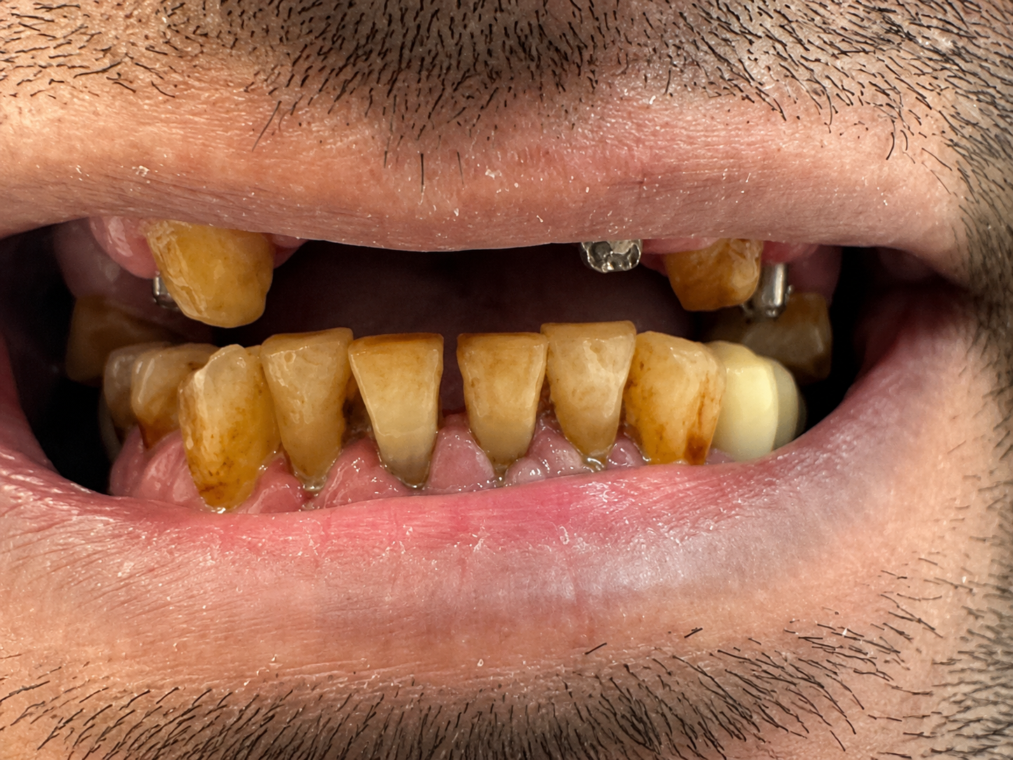 Veneers Before